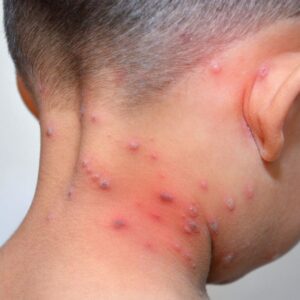 Young boy having the chicken pox.